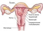 Лечение полипов эндометрия: виды и методы