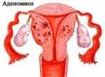 Аденомиоз матки: лечение, причины, симптомы