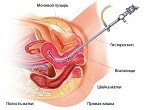 Гистероскопия перед ЭКО